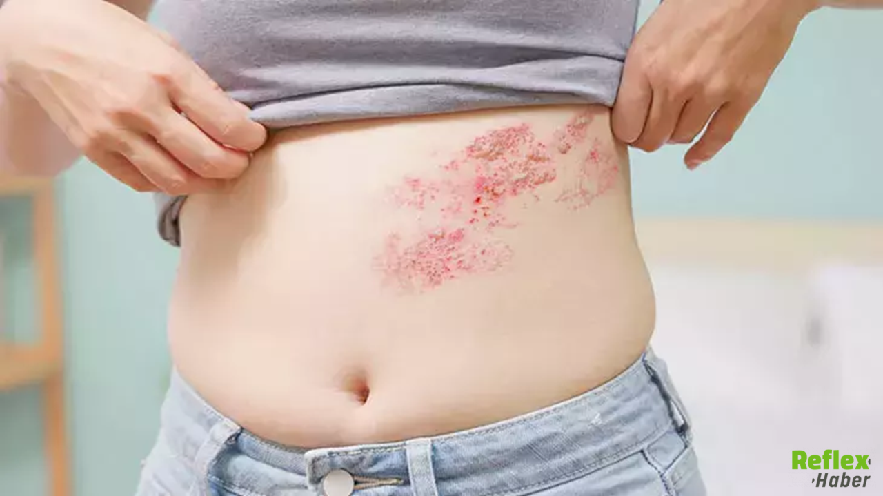 50 Yaş Üstü İçin Uyarı Zona Hastalığı Nasıl Ortaya Çıkar1