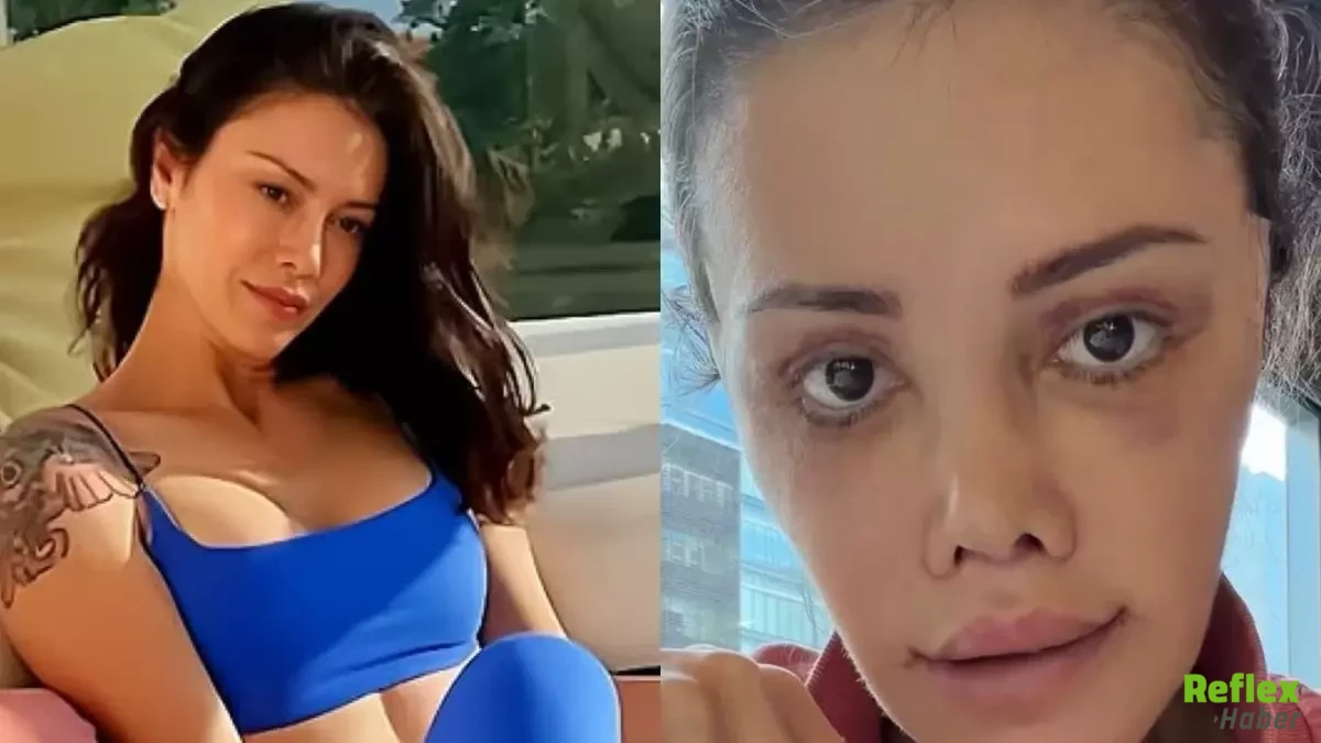Didem Ceran Neden Yuz Nakli Oldu 2