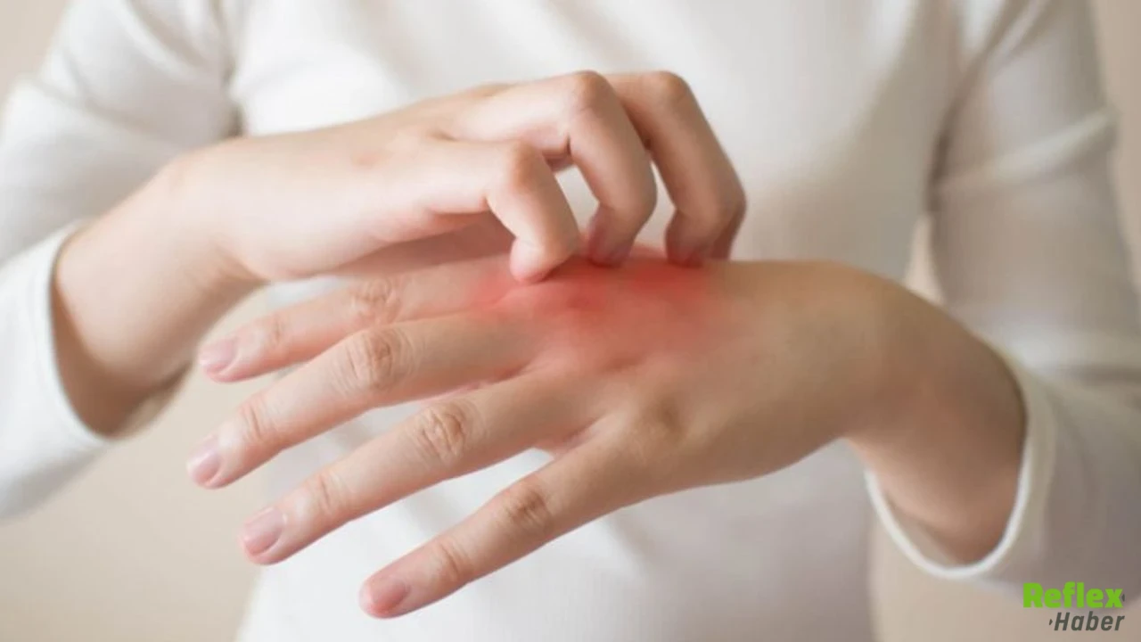 Egzama Neden Çıkar Ve Nasıl Kontrol Altına Alınırr