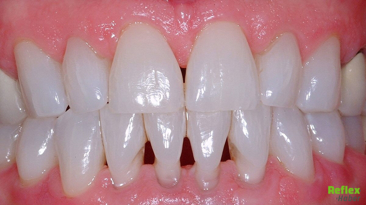 Diş Eti Çekilmesi Neden Olur Ne Iyi Gelir 1