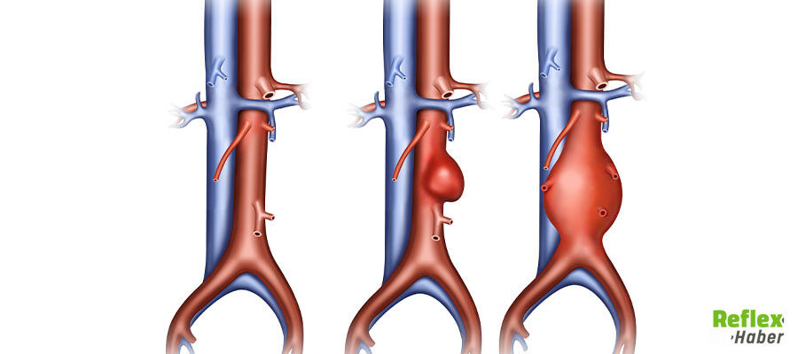 Aort Damarı Yırtılması Neden Olur 1