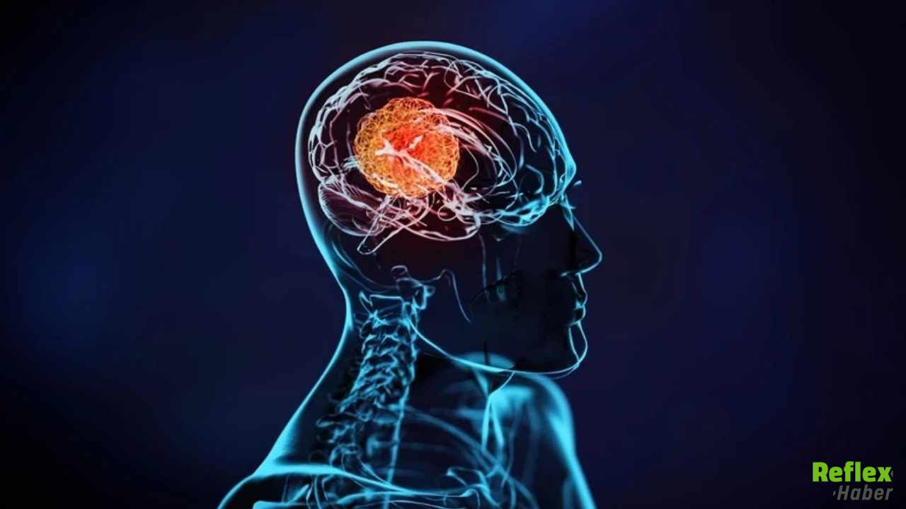 Baş Ağrısı Ve Unutkanlık Beyin Tümörünün Habercisi Olabilir-1