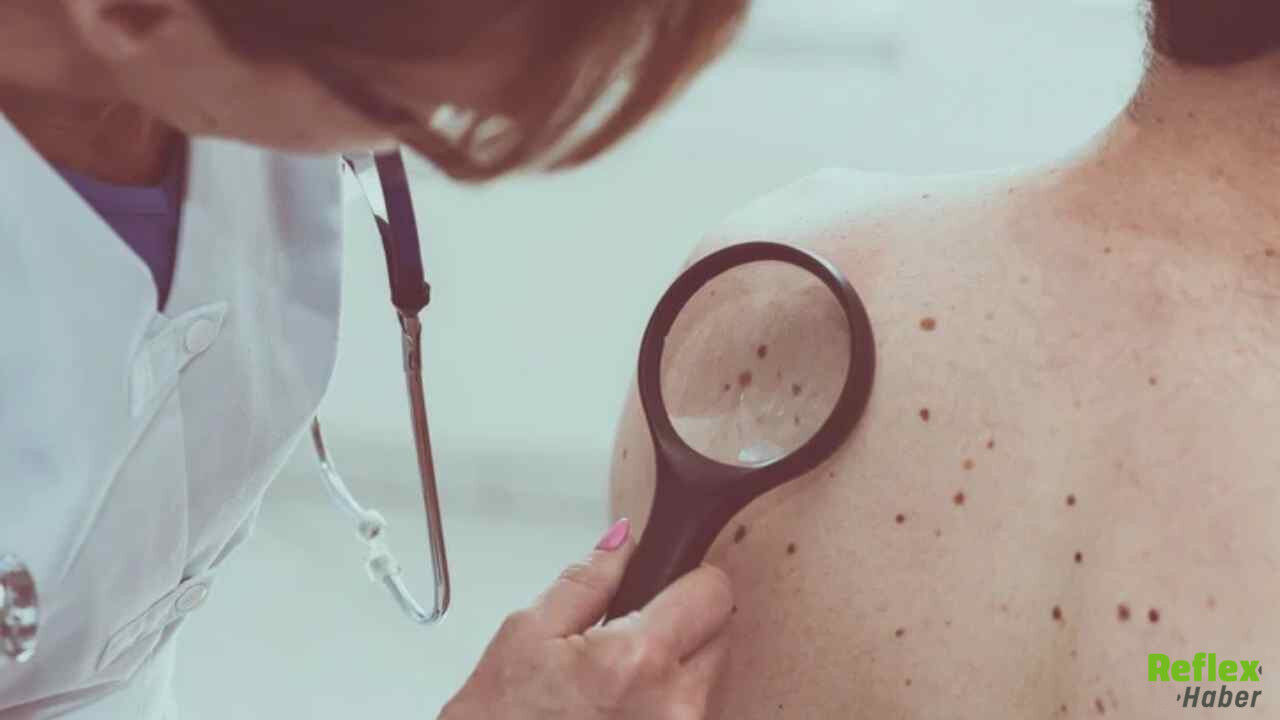 Cilt Kanserinde Küresel Tehlike 2050’Ye Kadar Vakalar Katlanabilir-1