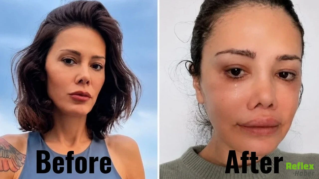 Didem Ceran Neden Yüz Nakli Yaptırd