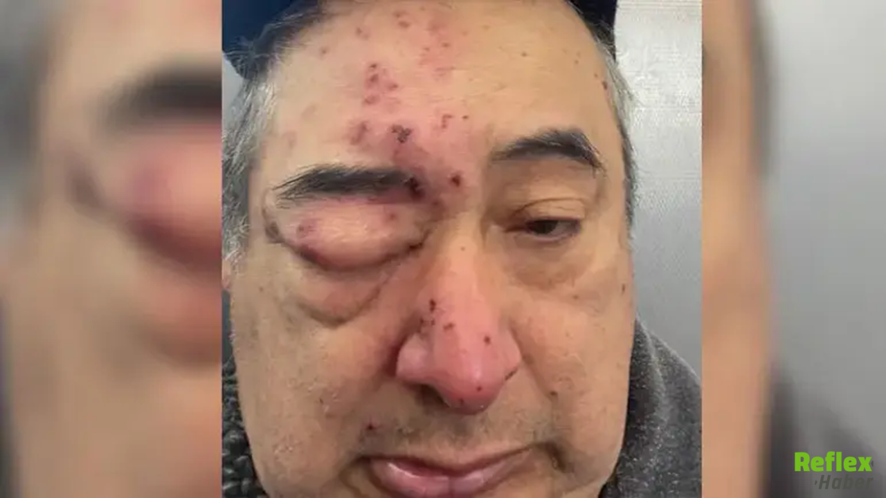 Evinde Uyurken Farelerin Saldırısına Uğradı! Yüzü Tanınmaz Hale Geldi1